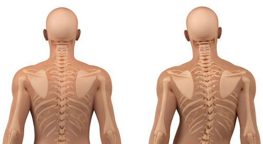 İdiopatik Skolyoz: Nedeni Bilinmeyen Skolyoz